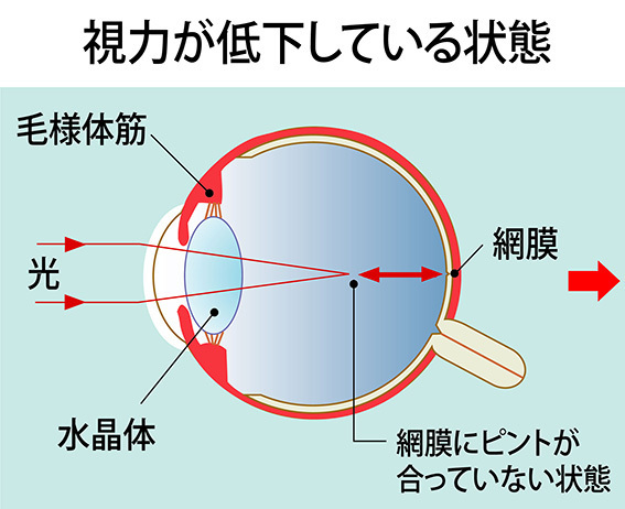 視力が低下した状態。毛様体筋がコリ固まっているため網膜より手前でピントが合っている。