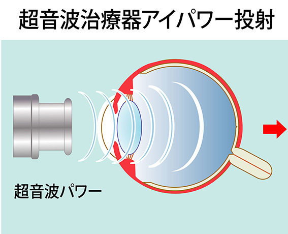 アイパワーの作用は❶毛様体筋のコリをほぐす❷血行をよくする